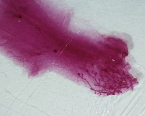 image of Breast Cancer