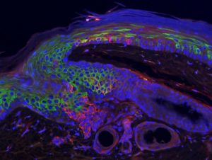 imagen de cancer de piel no carcinoma