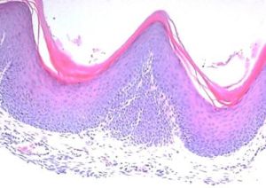 imagen de carcinoma escamoso de cabeza y cuello