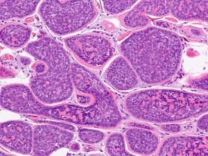 image of Rare Diseases Related to Cancer