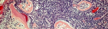 El CIEMAT/CIBERONC y el Instituto de Investigación i+12 describen el papel de la proteína IKKB en la formación de tumores odontogénicos