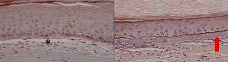 Improve the efficiency and accuracy of genomics edition for the treatment of epidermolysis bullosa